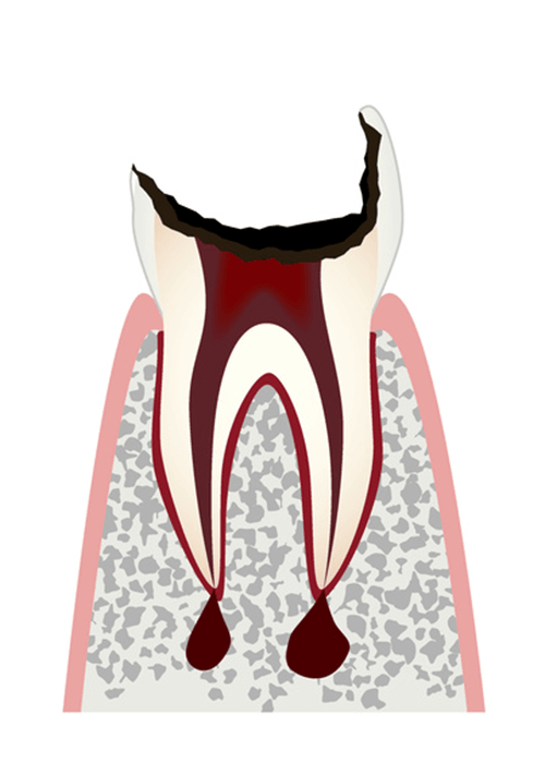 神経まで進行した虫歯