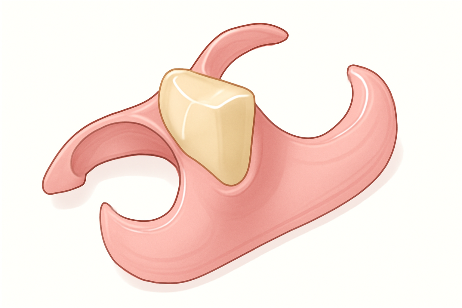 ノンクラスプデンチャーの実際:金属のバネを使わない自費治療の義歯は、審美性と機能性を両立する未来の義歯か、それともリスクを抱えた義歯なのか？