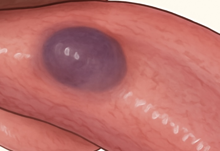 口腔内の血管腫・血管異常の原因と治療：多くの歯科医師が誤解している「血管腫」の定義