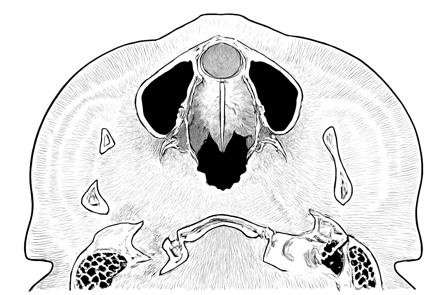 上顎の前歯の後ろに違和感！鼻口蓋管嚢胞(切歯管)の症状と病理と治療アプローチ