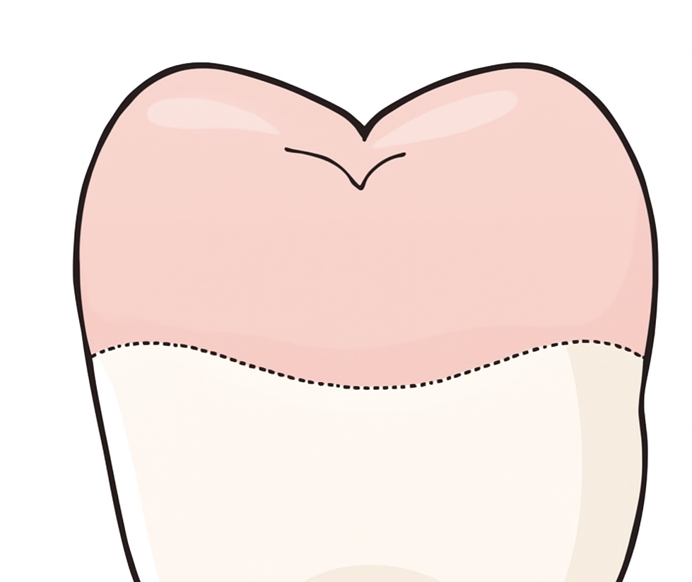 セラミックオーバーレイ修復：最小侵襲で最大限の歯質保存を行おう:メリットとデメリット