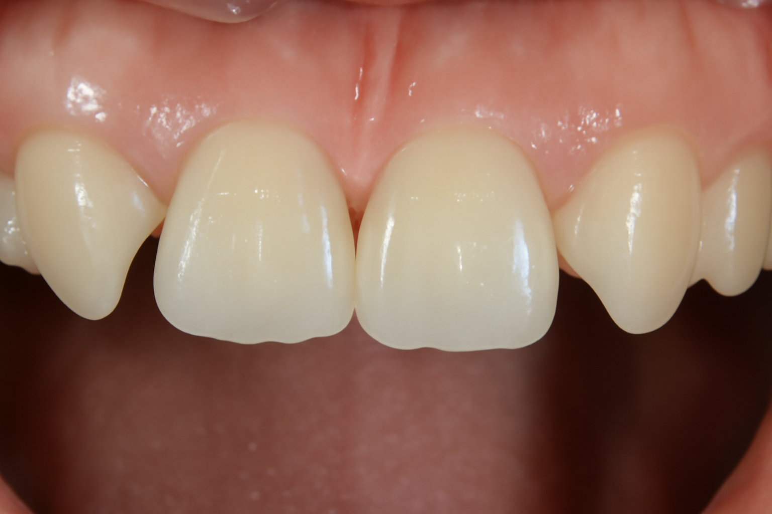 永久歯の先天性欠損：歯の数が少ない、足りない