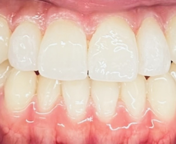 審美歯科治療「ラミネートベニア」：後悔しないための、エビデンスに基づく長期成功の秘訣