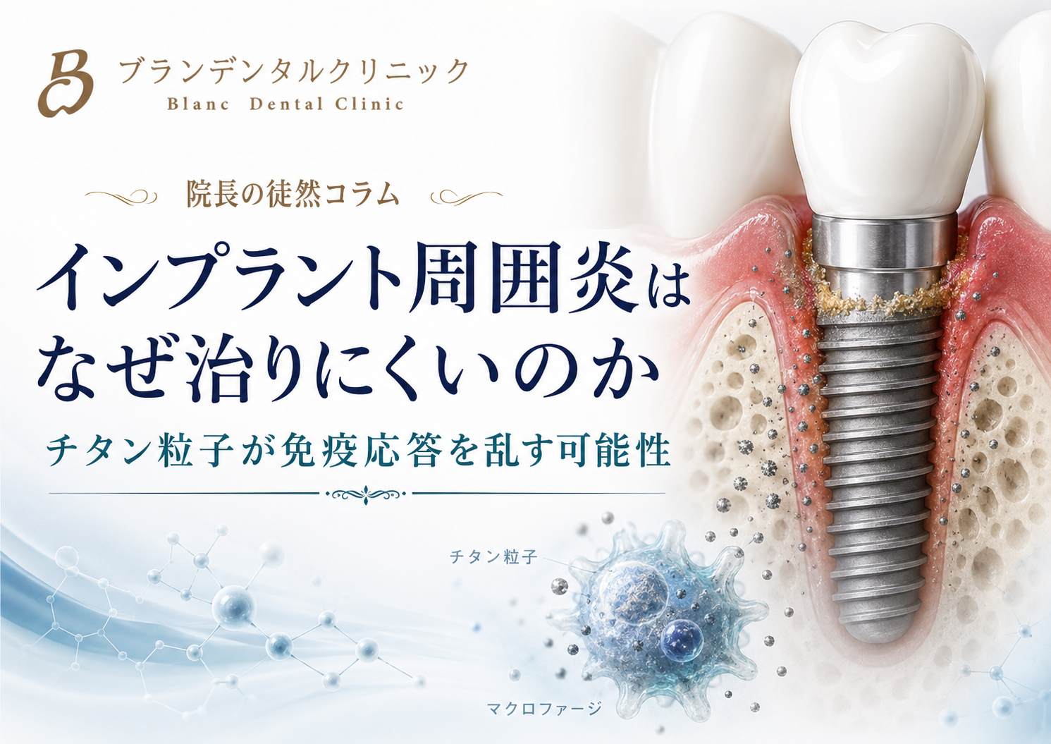 インプラント周囲炎はなぜ治りにくいのか：チタン粒子が免疫応答を乱す可能性