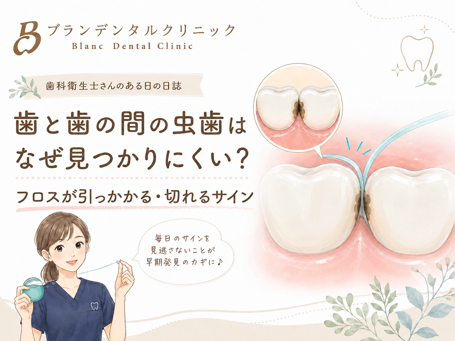 歯と歯の間の虫歯はなぜ見つかりにくい？フロスが引っかかる・切れるサイン