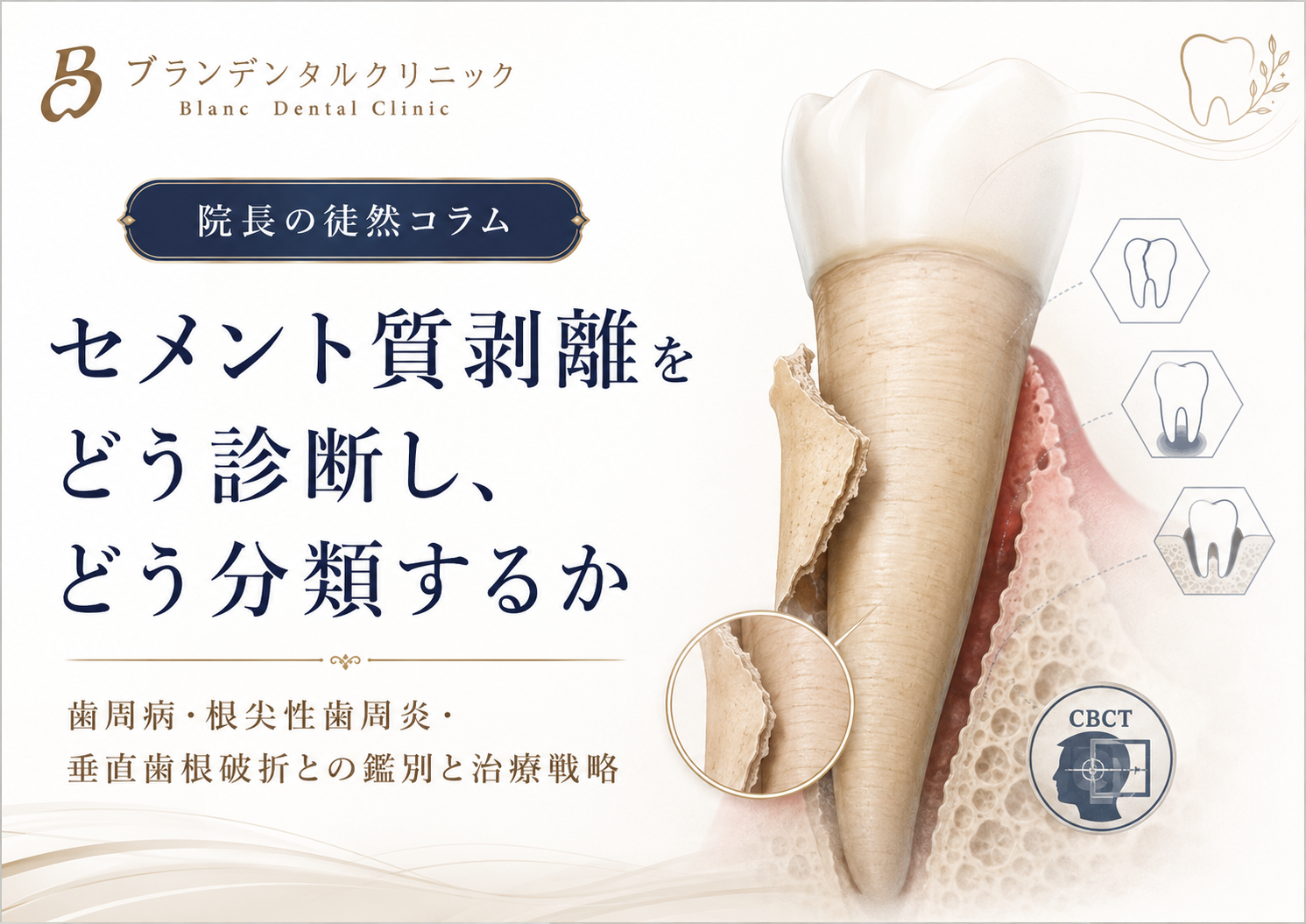 セメント質剥離をどう診断し、どう分類するか：歯周病・根尖性歯周炎・垂直歯根破折との鑑別と治療戦略