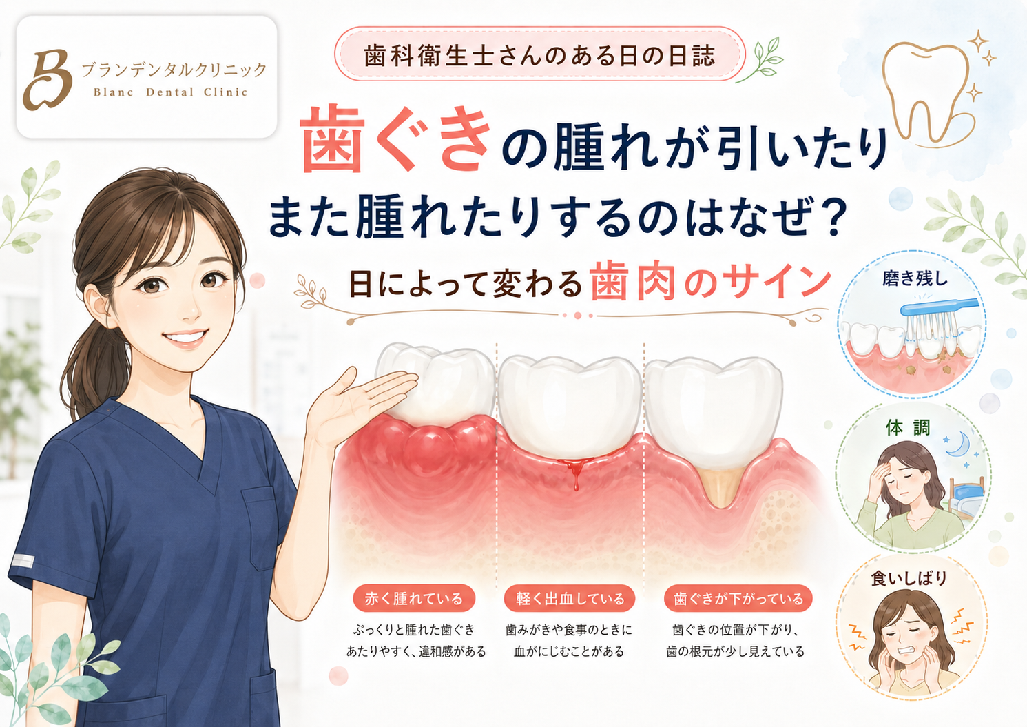 歯ぐきの腫れが引いたりまた腫れたりするのはなぜ？日によって変わる歯肉のサイン