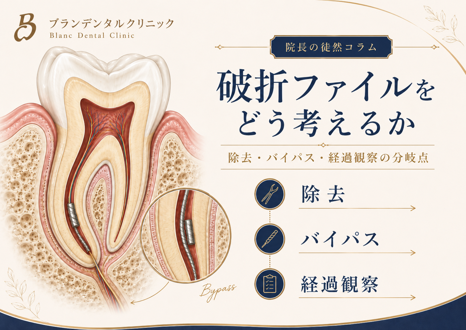 破折ファイルをどう考えるか：除去・バイパス・経過観察の分岐点