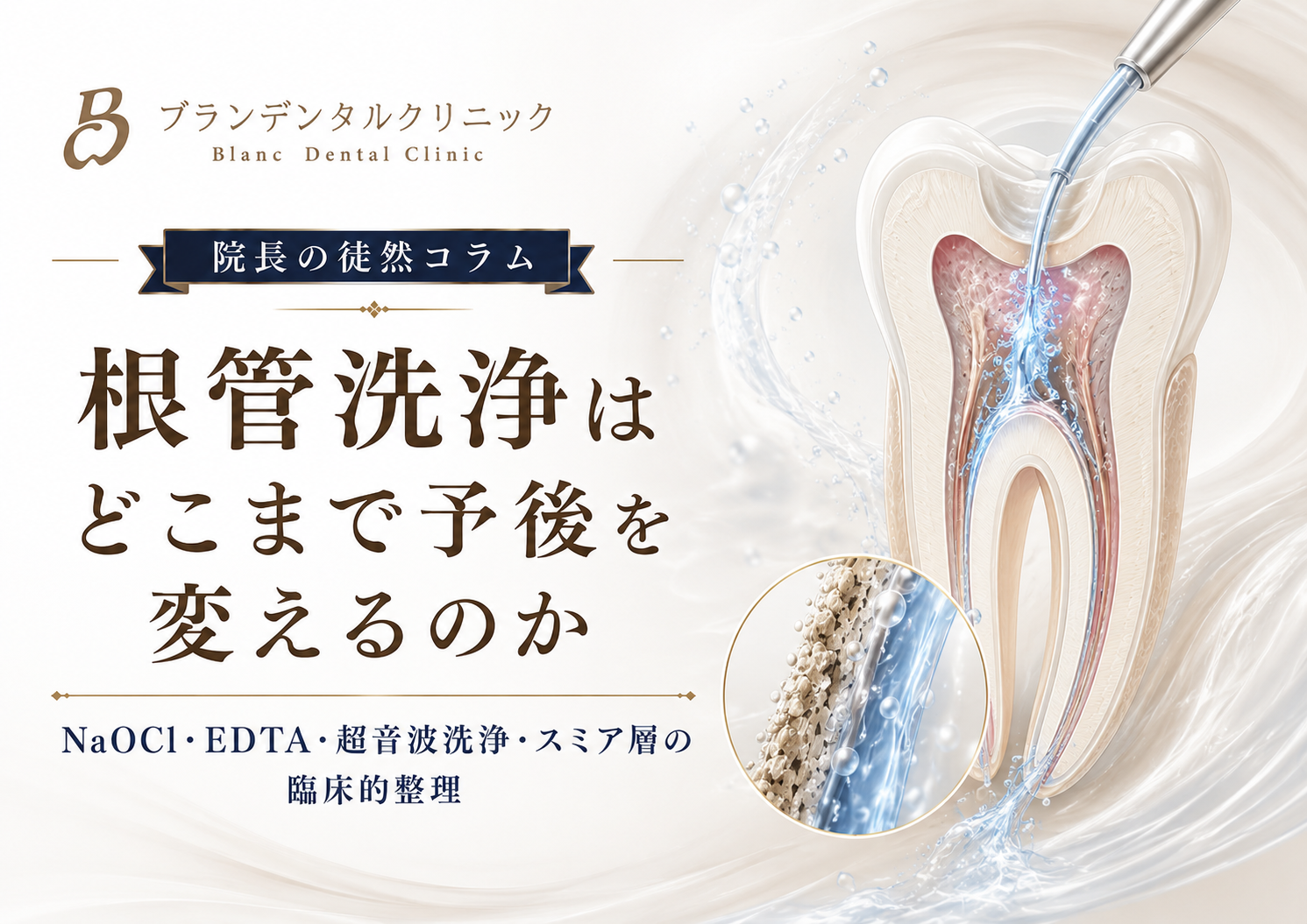 根管洗浄はどこまで予後を変えるのか：NaOCl・EDTA・超音波洗浄・スミヤー層を臨床アウトカムから再考する