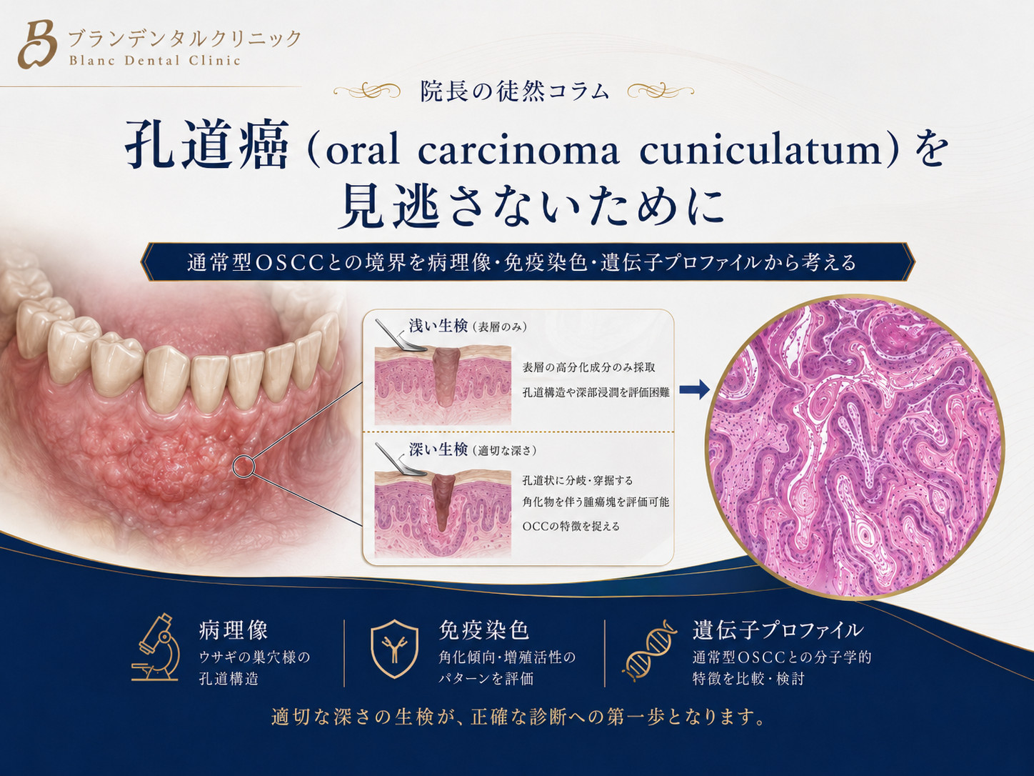 孔道癌（oral carcinoma cuniculatum）を見逃さないために