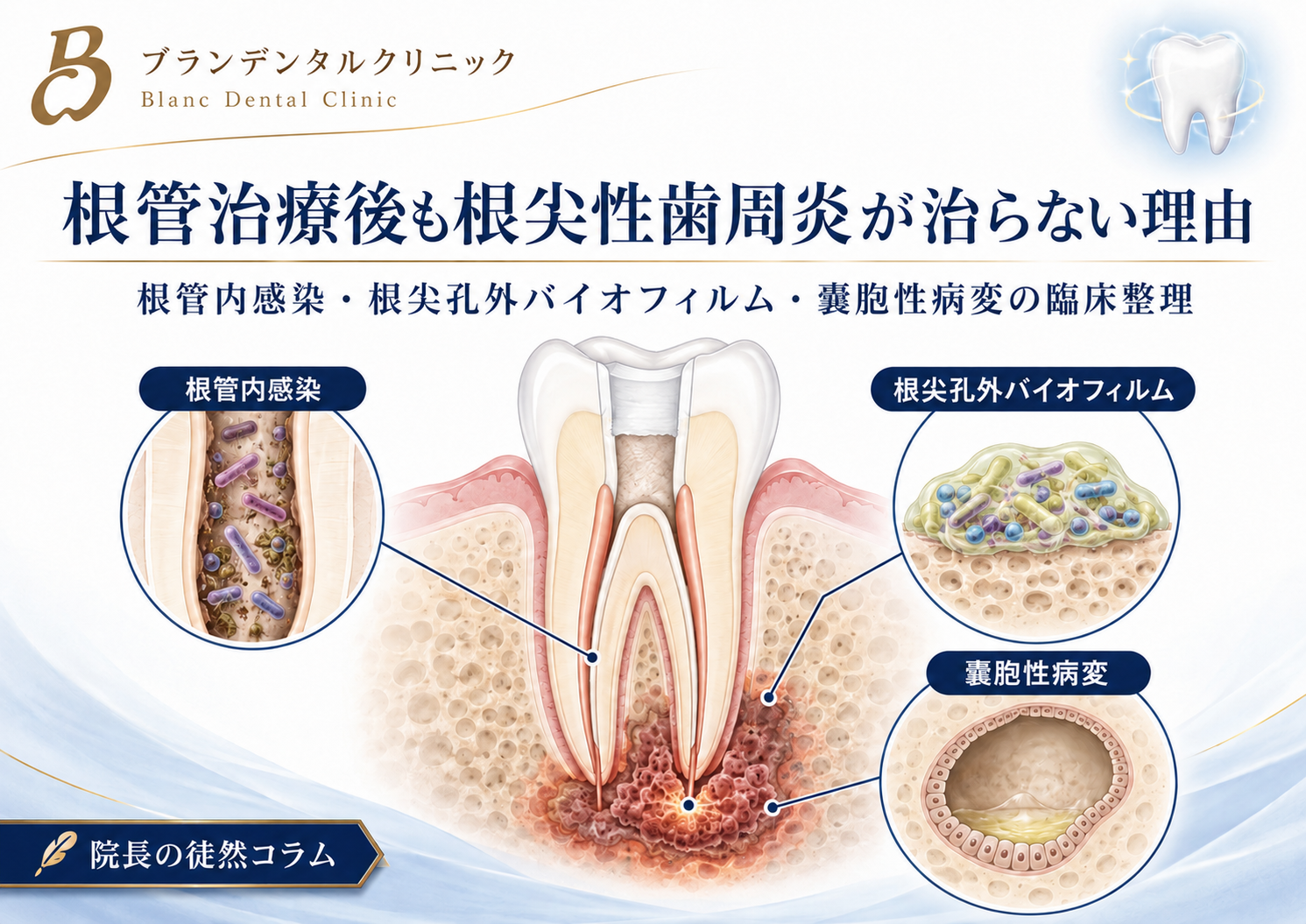 根管治療後も根尖性歯周炎が治らない理由：根管内感染・根尖孔外バイオフィルム・嚢胞性病変の臨床整理
