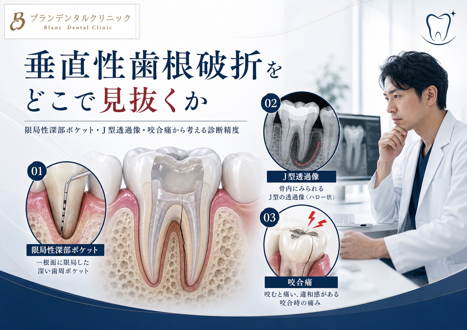 垂直性歯根破折はなぜ見逃されるのか：限局性深部ポケット・J型透過像・咬合痛から考える診断の限界