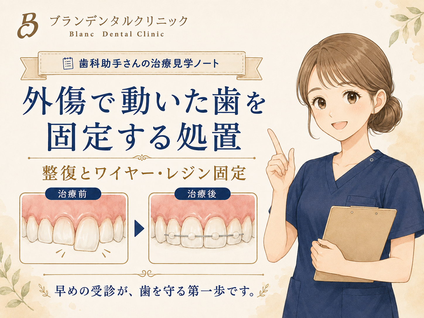 歯をぶつけてグラグラする歯はどう固定する？外傷歯の整復とワイヤー・レジン固定