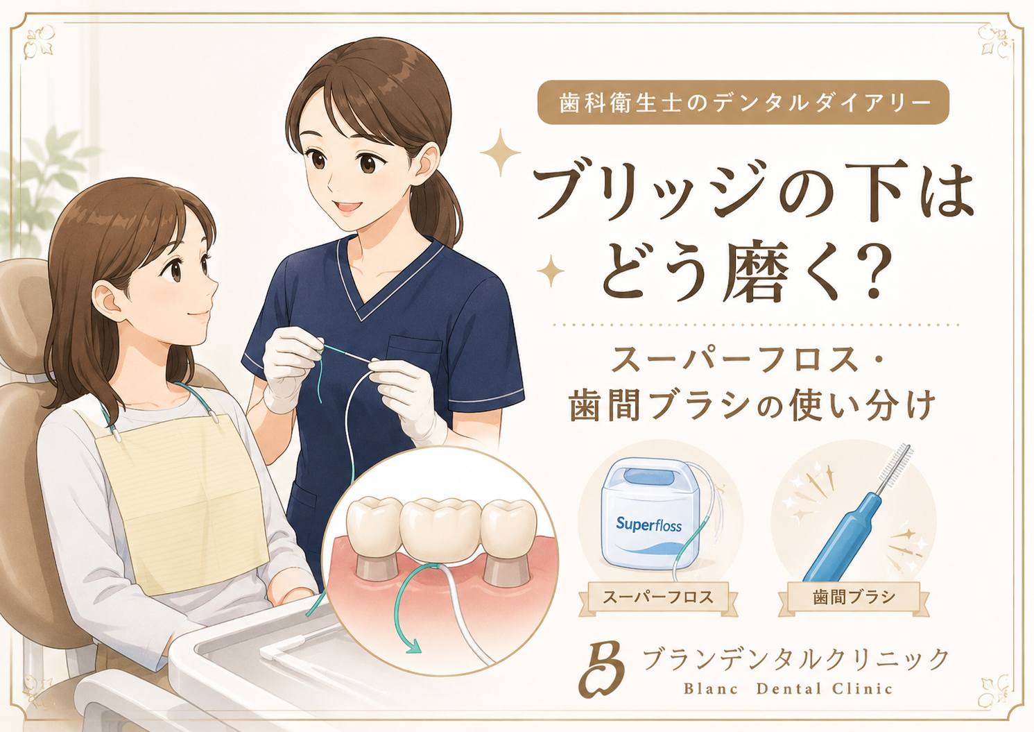 ブリッジの下はどう磨く？スーパーフロス・歯間ブラシの使い分け