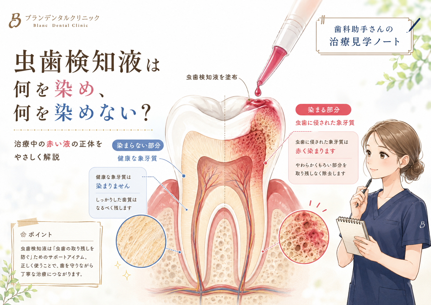 虫歯治療で赤い液を塗るのはなぜ？虫歯検知液は何を染め、何を染めない？