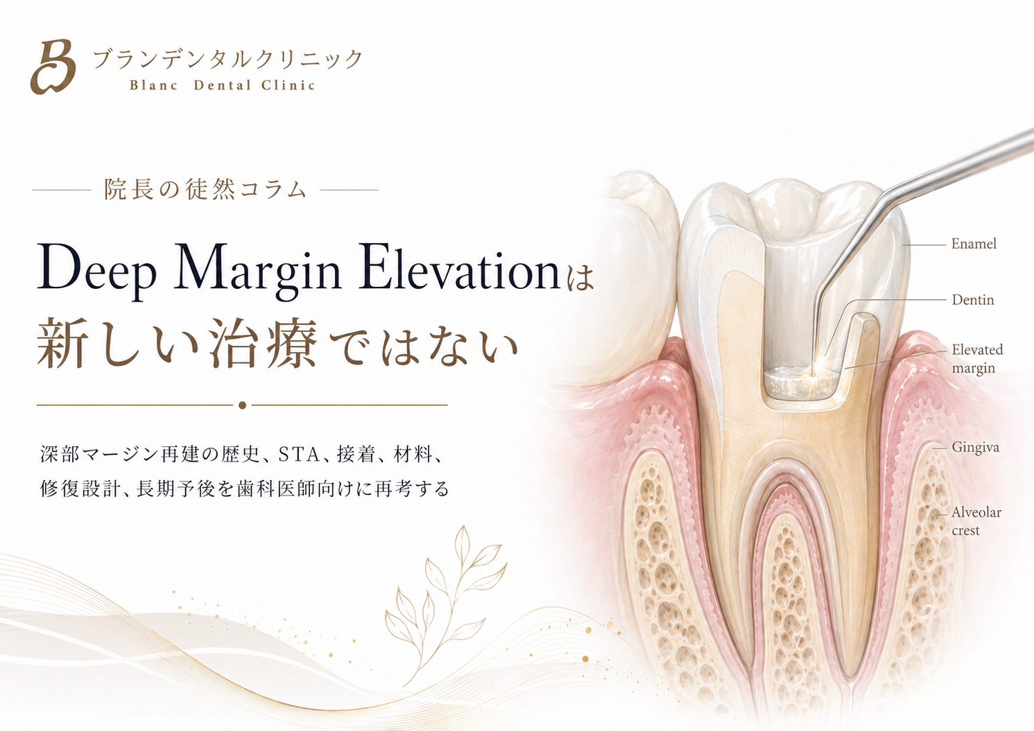 Deep Margin Elevationは新しい治療ではない:深部マージン再建の歴史、STA、接着、材料、修復設計、長期予後再考