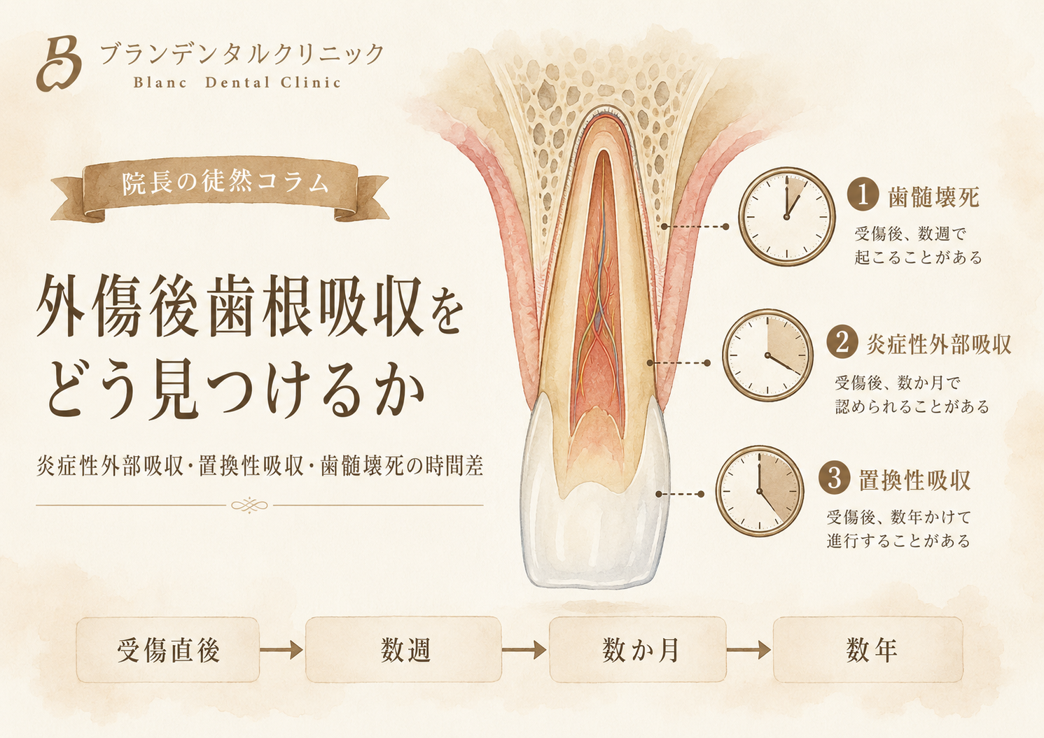 外傷後歯根吸収をどう見つけるか：炎症性外部吸収・置換性吸収・歯髄壊死の時間差