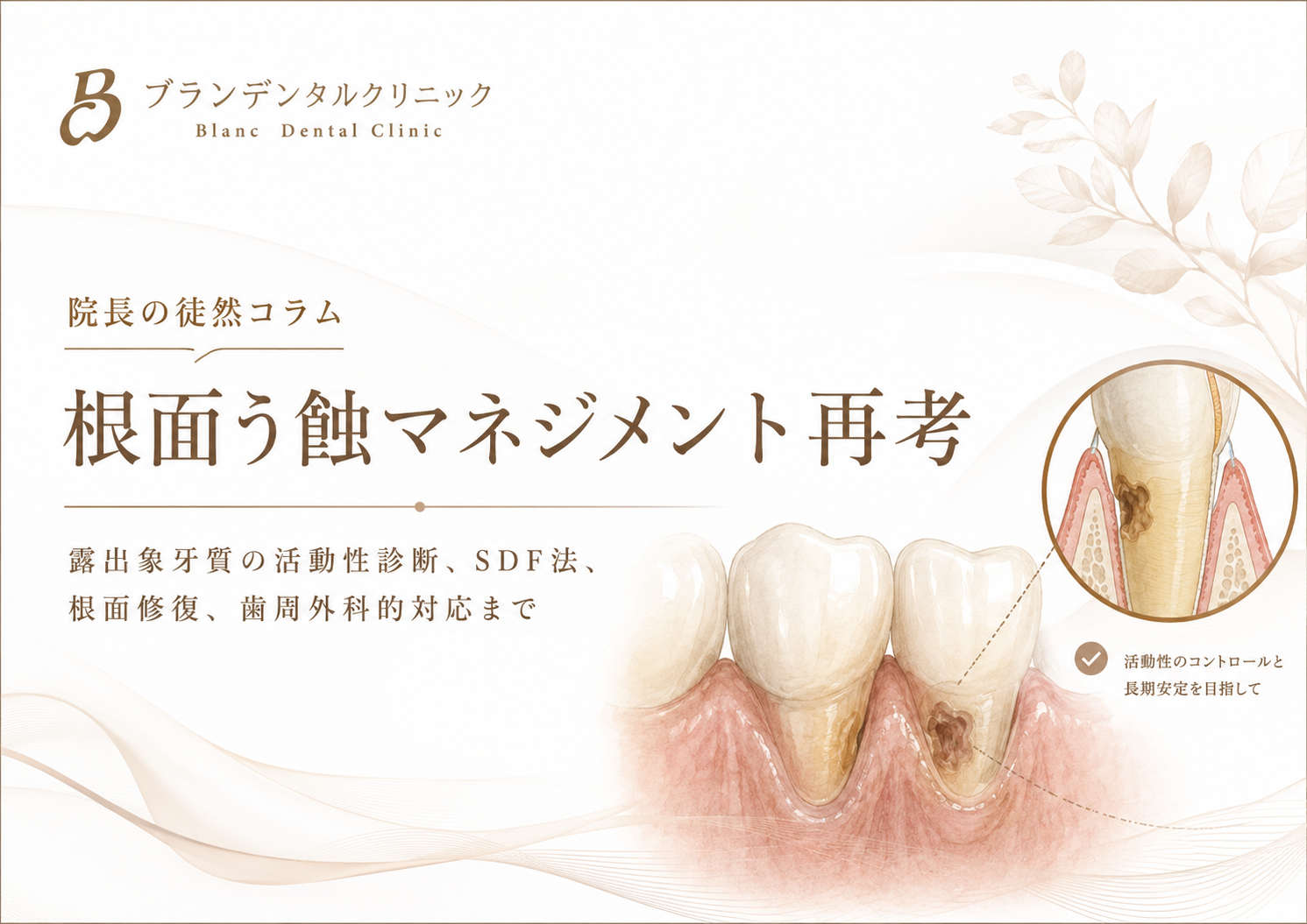 根面う蝕マネジメント再考:露出象牙質の活動性診断、SDF法、根面修復、歯周外科的対応まで