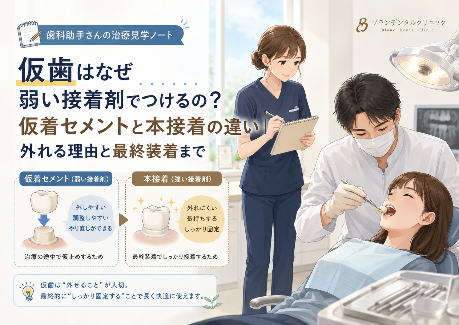 「仮歯はなぜ弱い接着剤でつけるの？仮着セメントと本接着の違い｜外れる理由と最終装着まで」