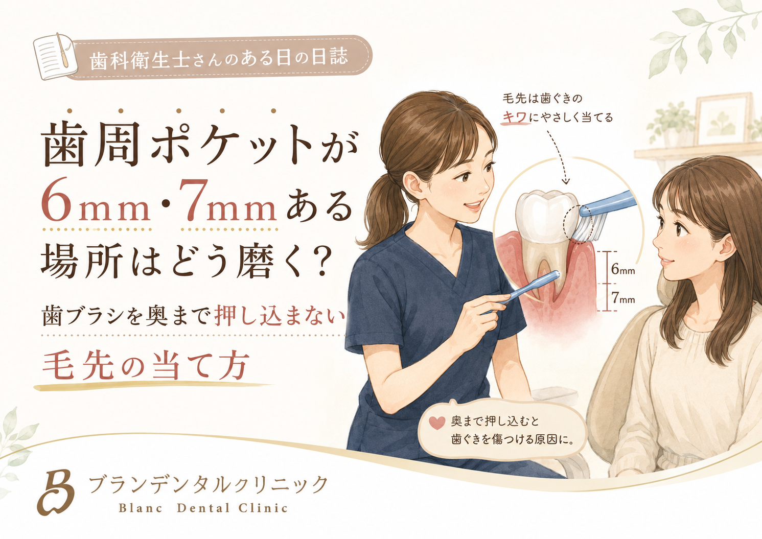 歯周ポケットが6mm・7mmある場所はどう磨く？歯ブラシを奥まで押し込まない毛先の当て方
