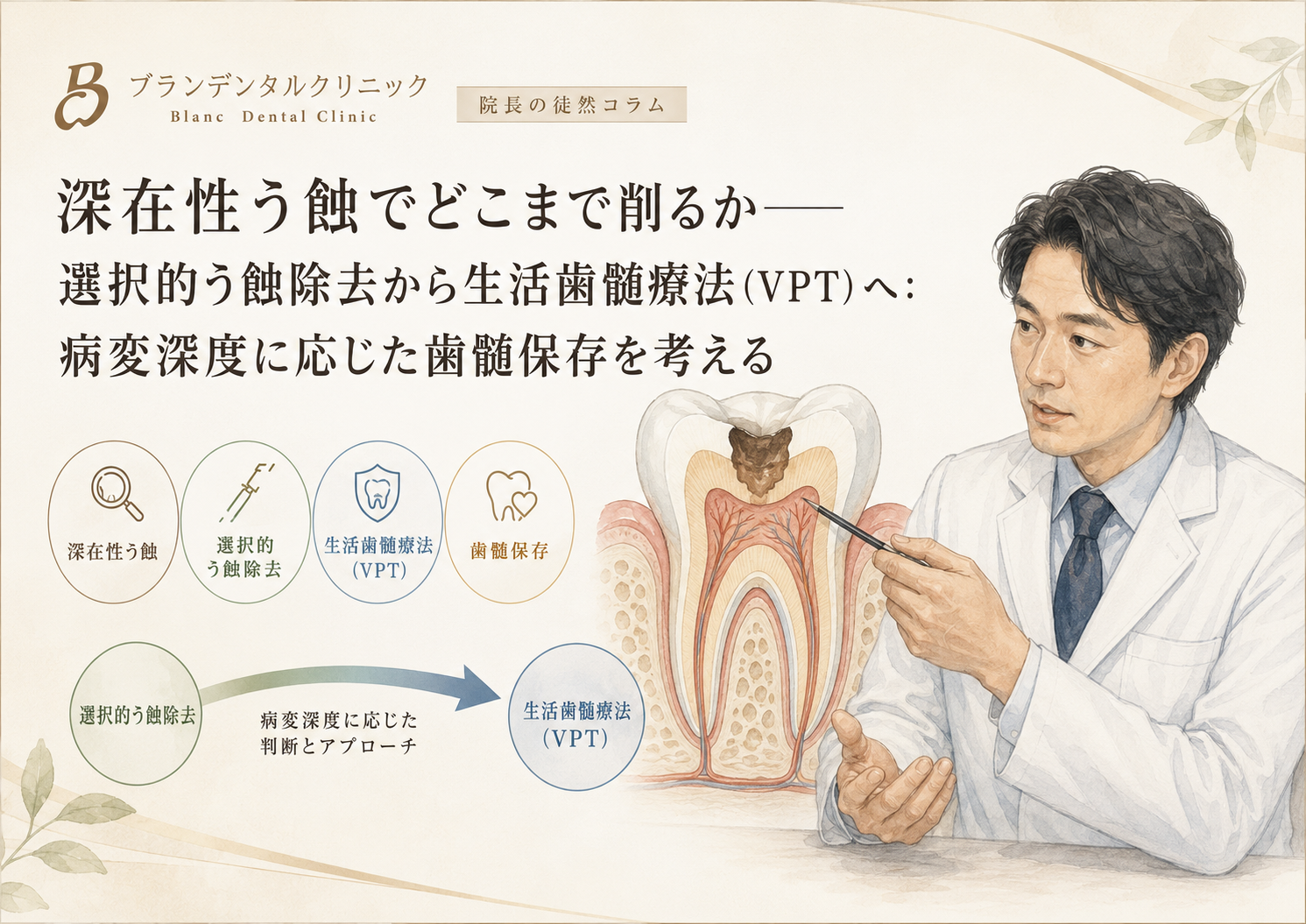 深在性う蝕でどこまで削るか？選択的う蝕除去から生活歯髄療法（VPT）へ：病変深度に応じた歯髄保存を考える