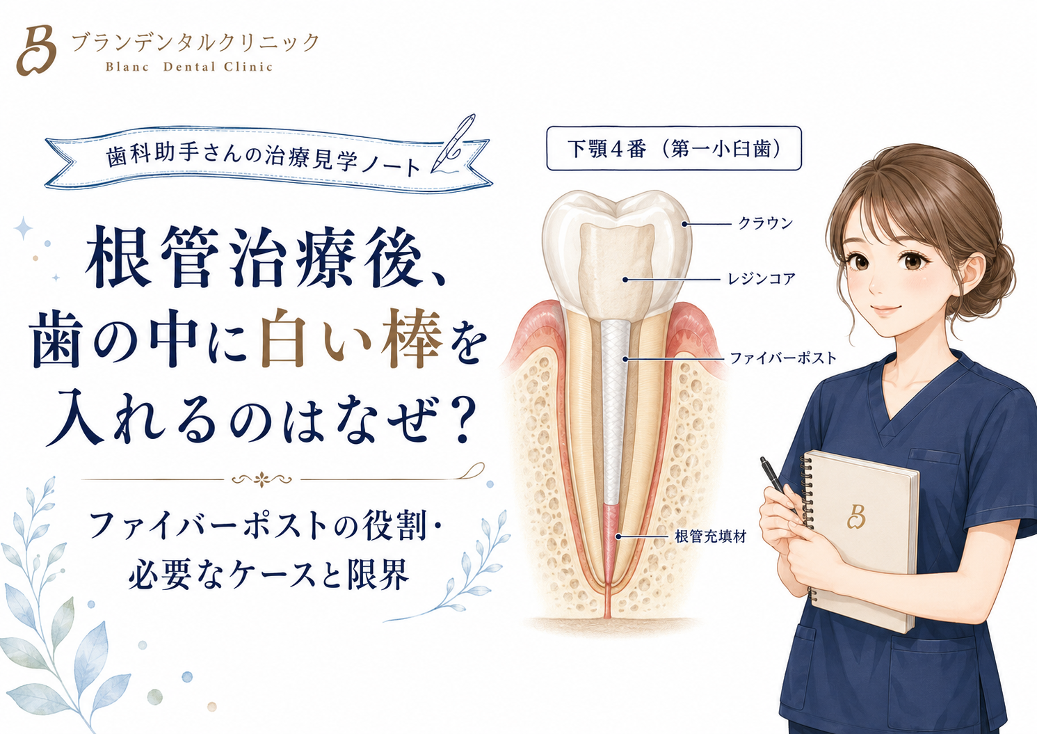 根管治療後、歯の中に白い棒を入れるのはなぜ？ファイバーポストの役割・必要なケースと限界