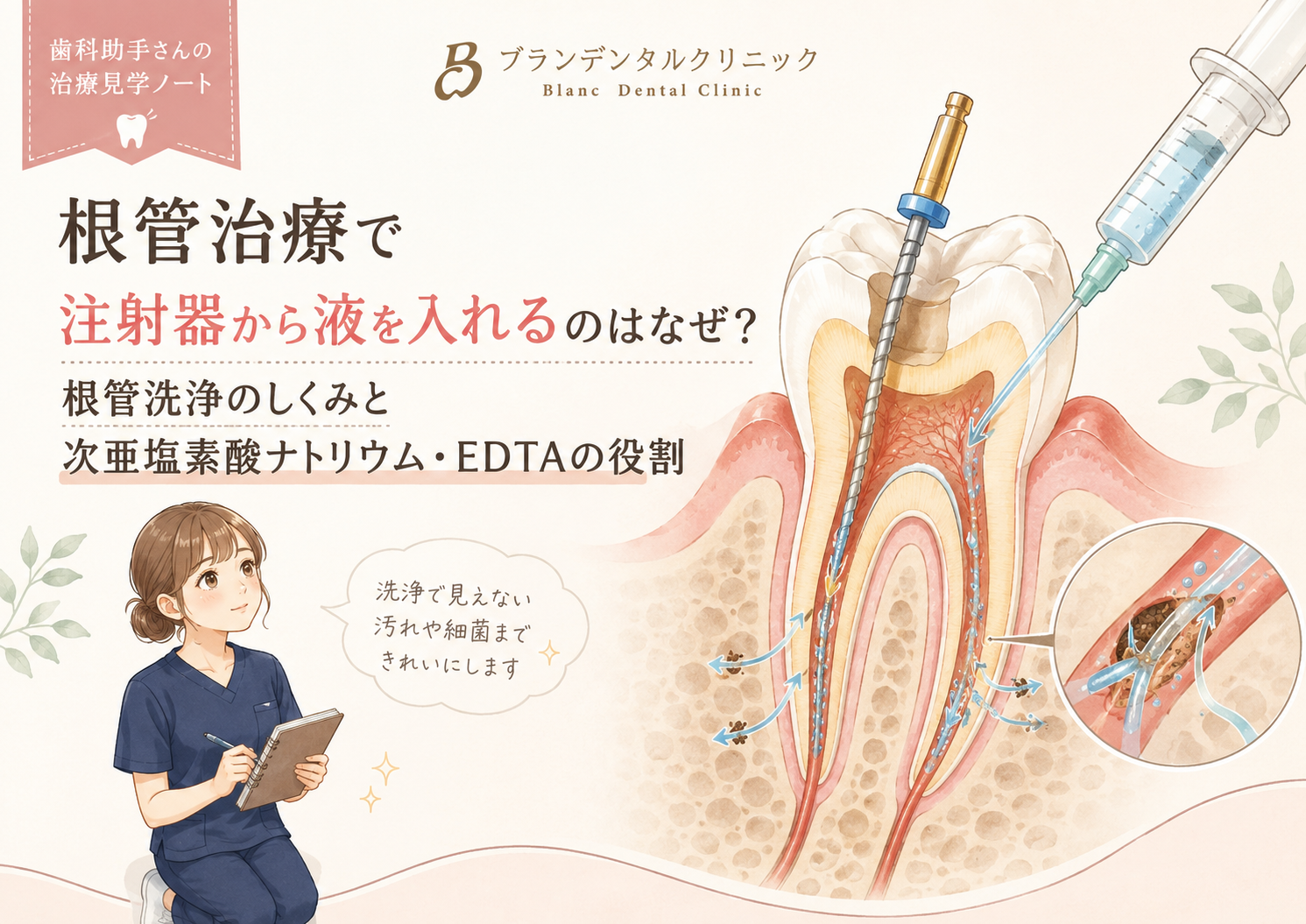 根管治療で注射器から液を入れるのはなぜ?根管洗浄のしくみと次亜塩素酸ナトリウム・EDTAの役割