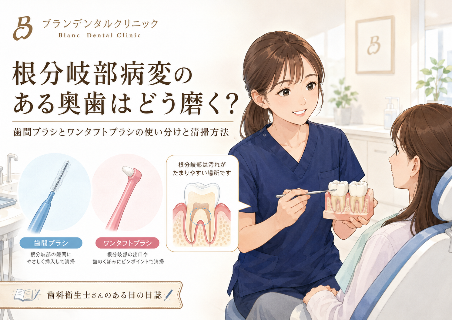根分岐部病変のある奥歯はどう磨く？歯間ブラシとワンタフトブラシの使い分けと清掃方法