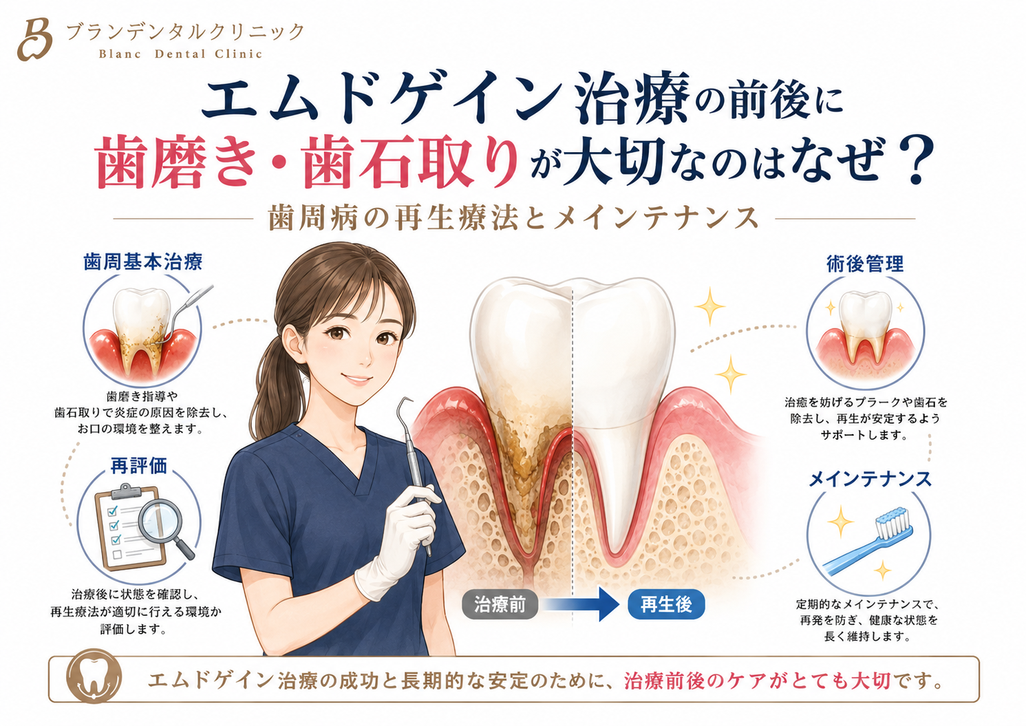 エムドゲイン治療の前後に歯磨き・歯石取りが大切なのはなぜ？歯周病の再生療法とメインテナンス