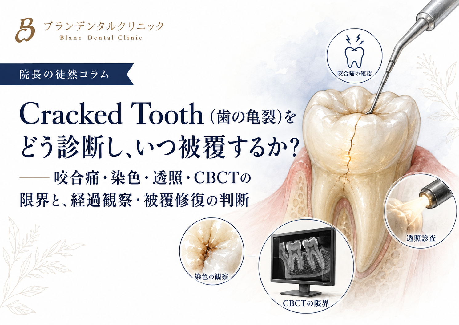 Cracked Tooth(歯の亀裂)をどう診断し、いつ被覆するか?咬合痛・染色・透照・CBCTの限界と、経過観察・被覆修復の判断