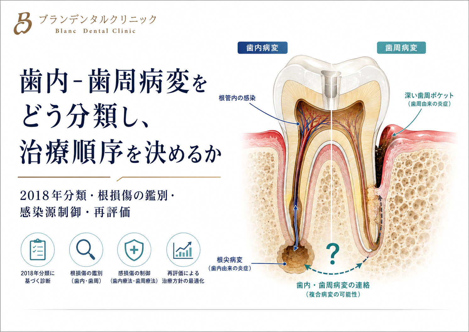 歯内‐歯周病変をどう分類し、治療順序を決めるか：2018年分類、根損傷の鑑別、感染源制御、再評価、再生療法まで