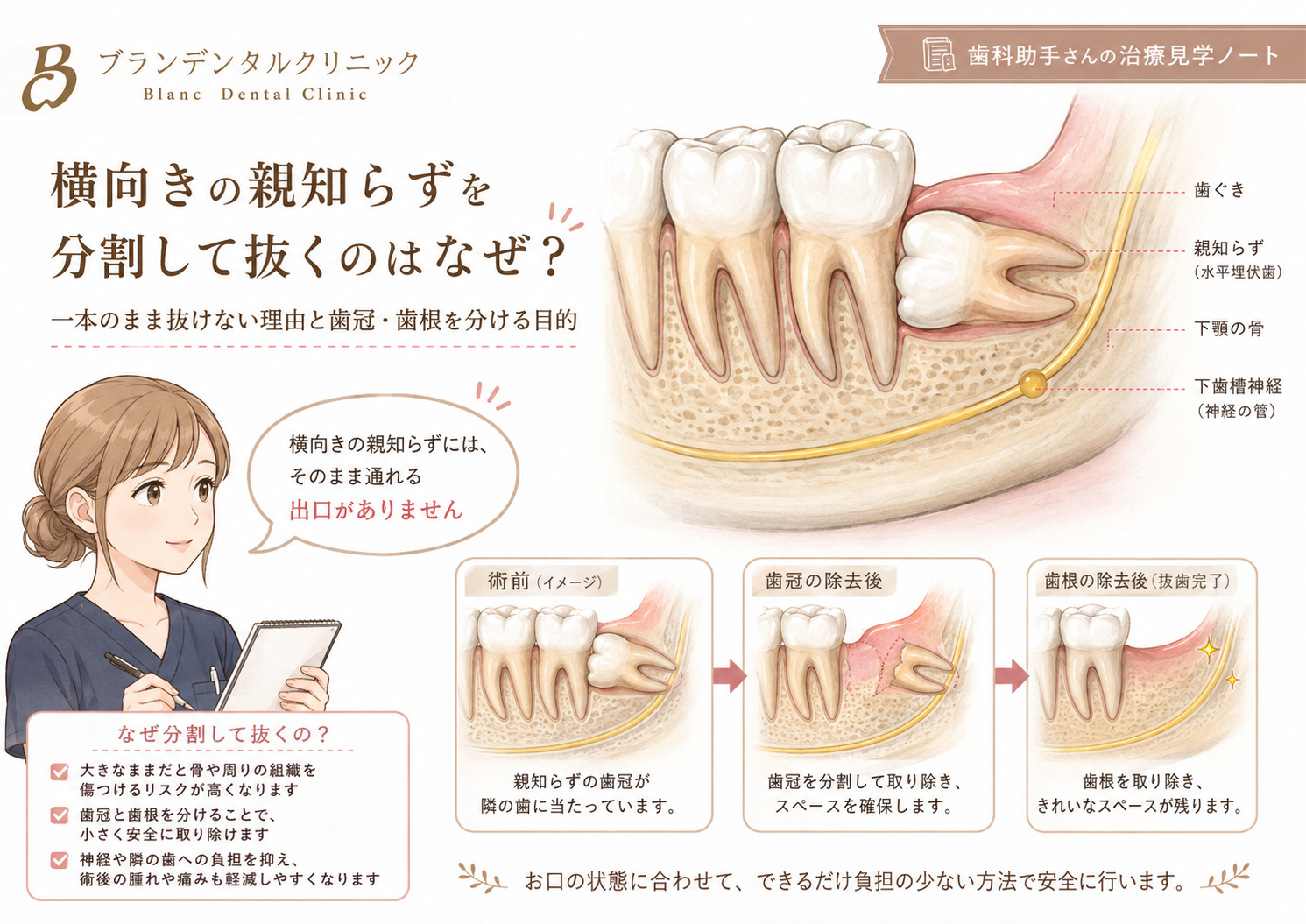 横向きの親知らずを分割して抜くのはなぜ？一本のまま抜けない理由と歯冠・歯根を分ける目的