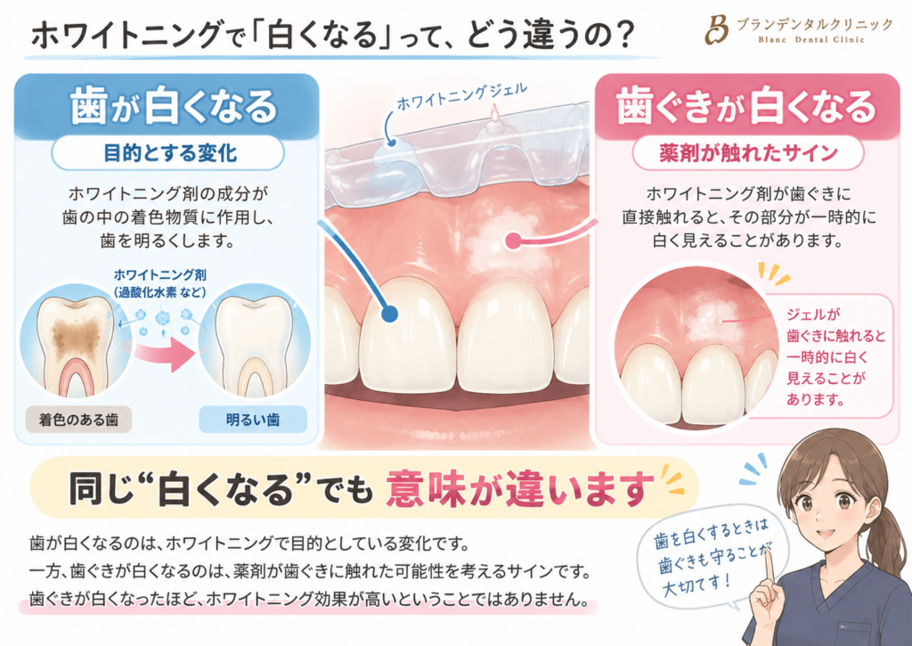 ホワイトニング中に歯ぐきが白くなった！薬剤が触れたサインと対処法