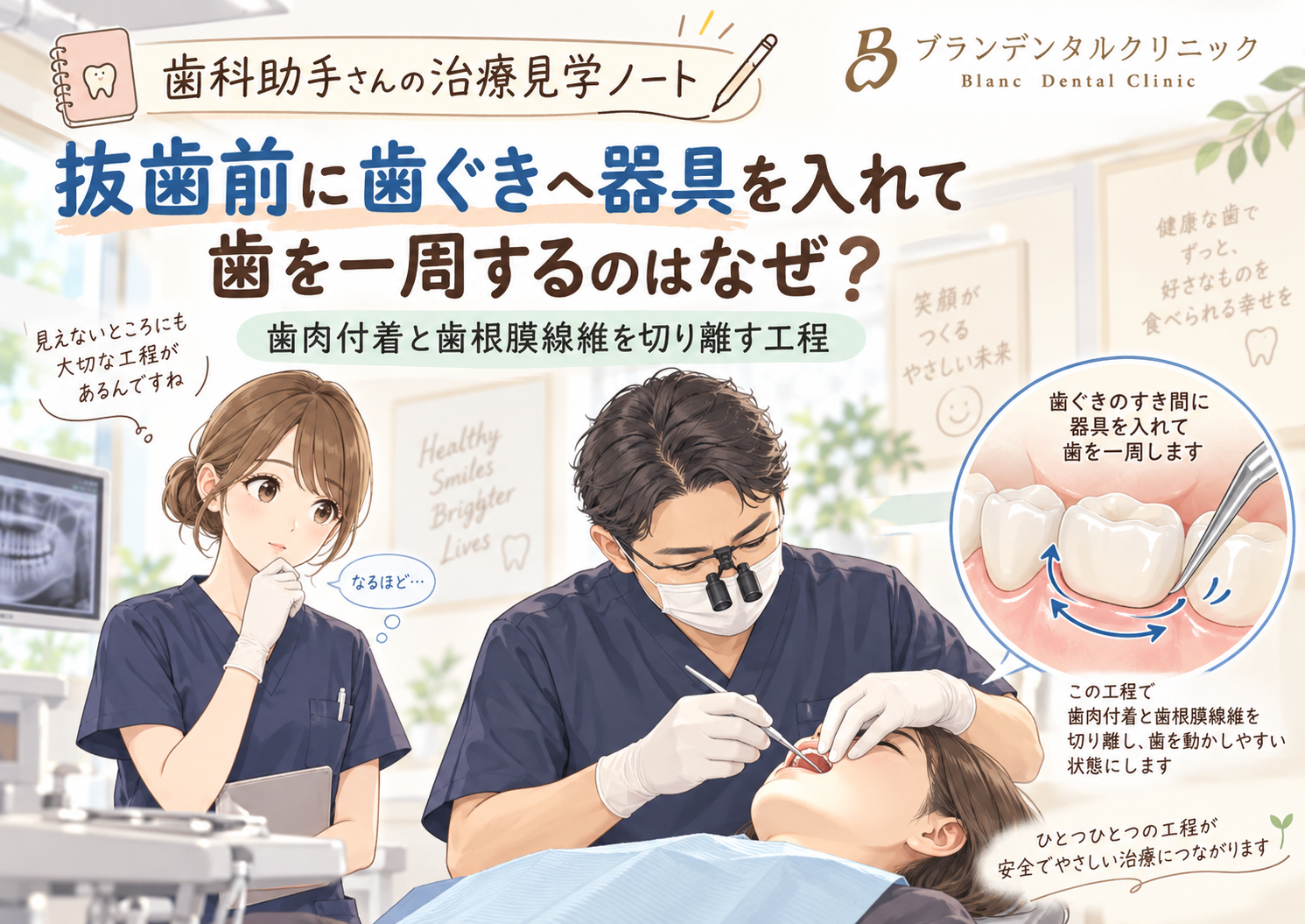 抜歯前に歯ぐきへ器具を入れて歯を一周するのはなぜ？歯肉付着と歯根膜線維を切り離す工程