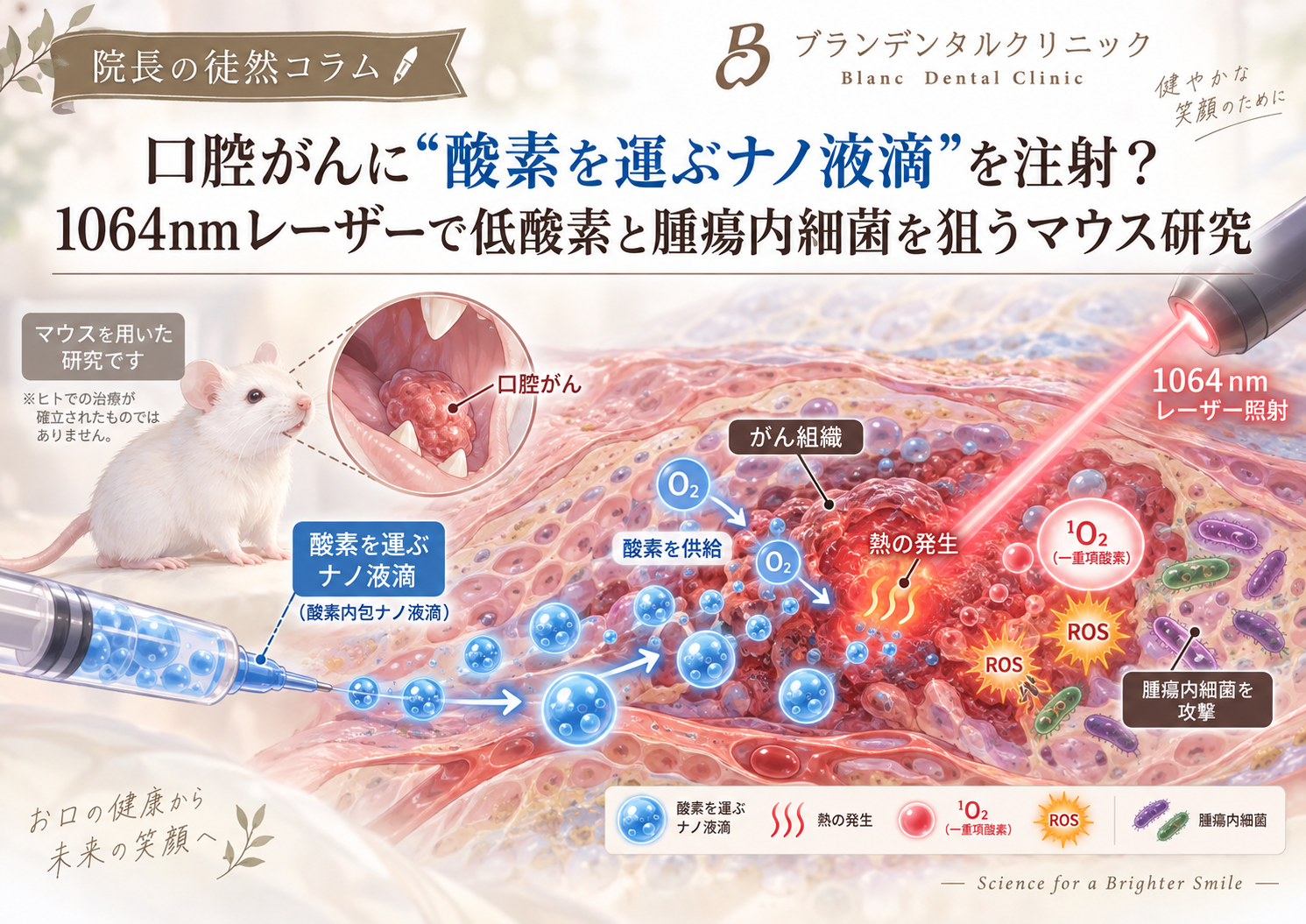 口腔がんに“酸素を運ぶナノ液滴”を注射？1064nmレーザーで低酸素と腫瘍内細菌を狙うマウス研究