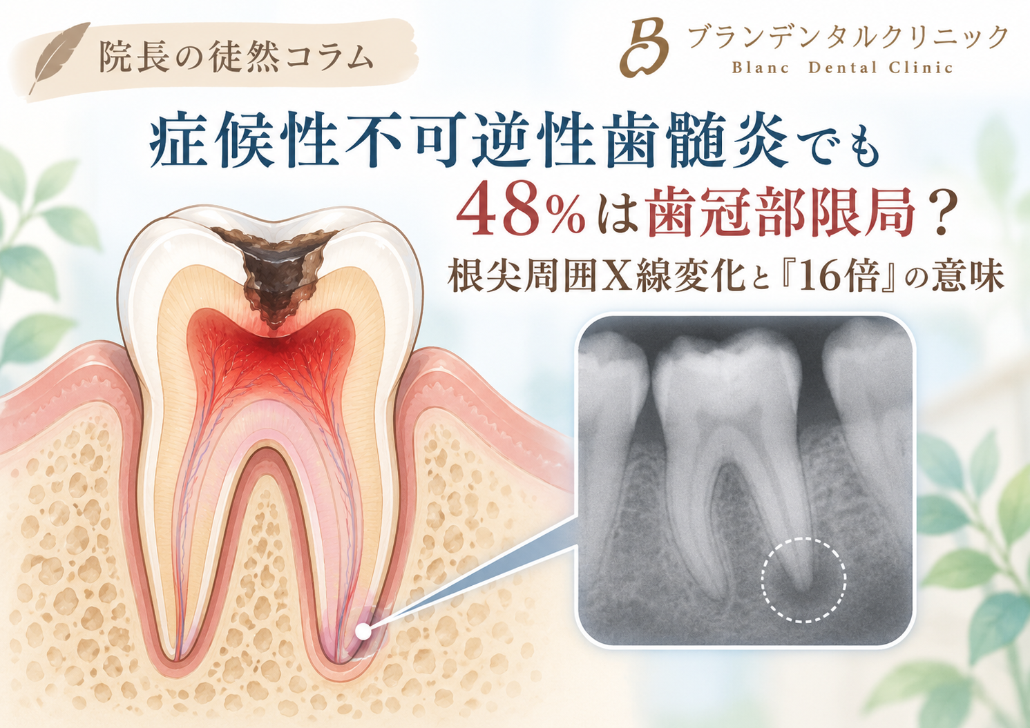 症候性不可逆性歯髄炎でも48％は歯冠部限局？根尖周囲X線変化と「16倍」の意味